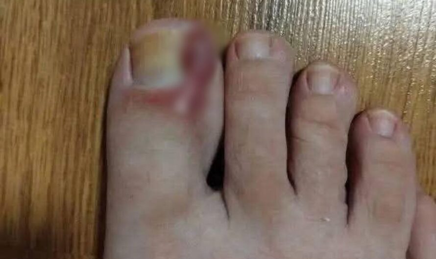 How to Treat an Ingrown Toenail at Home: Tips and Natural Remedies