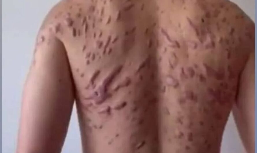 Acne occurs when hair follicles become clogged