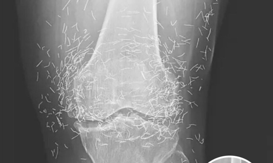 Doctors Stunned After Looking At This X-Ray Of Woman Suffering Joint Pain