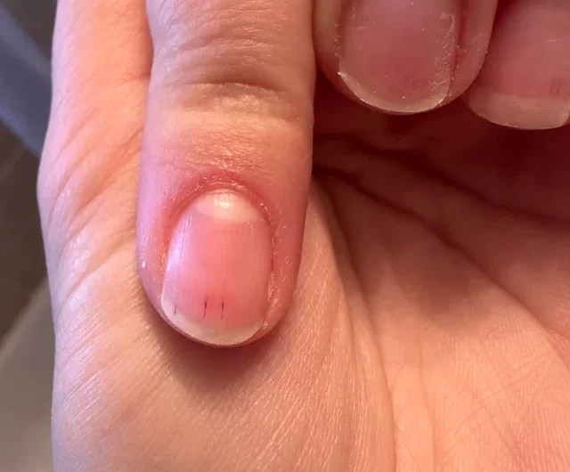 If You Notice These Lines on Your Nails After 40, Here’s What It Really Means